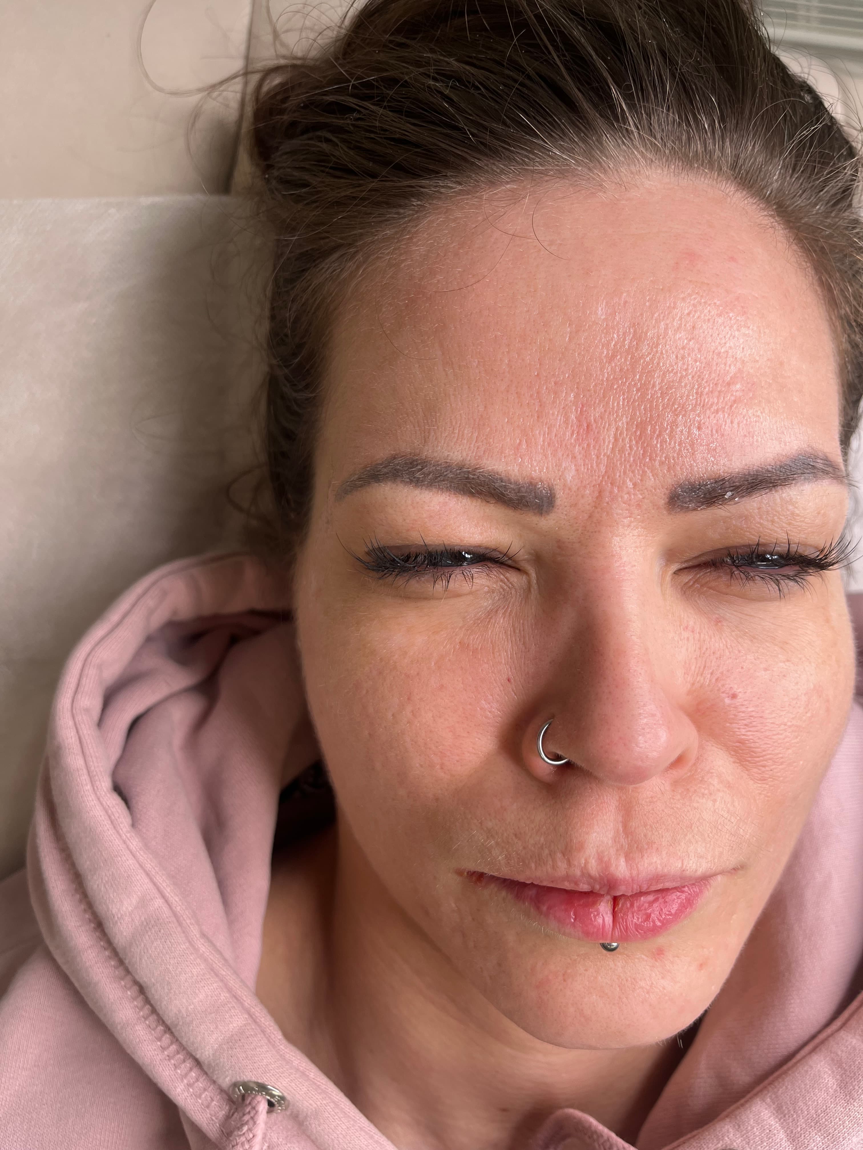 Efter botox — slätare glabella, avslappnat uttryck