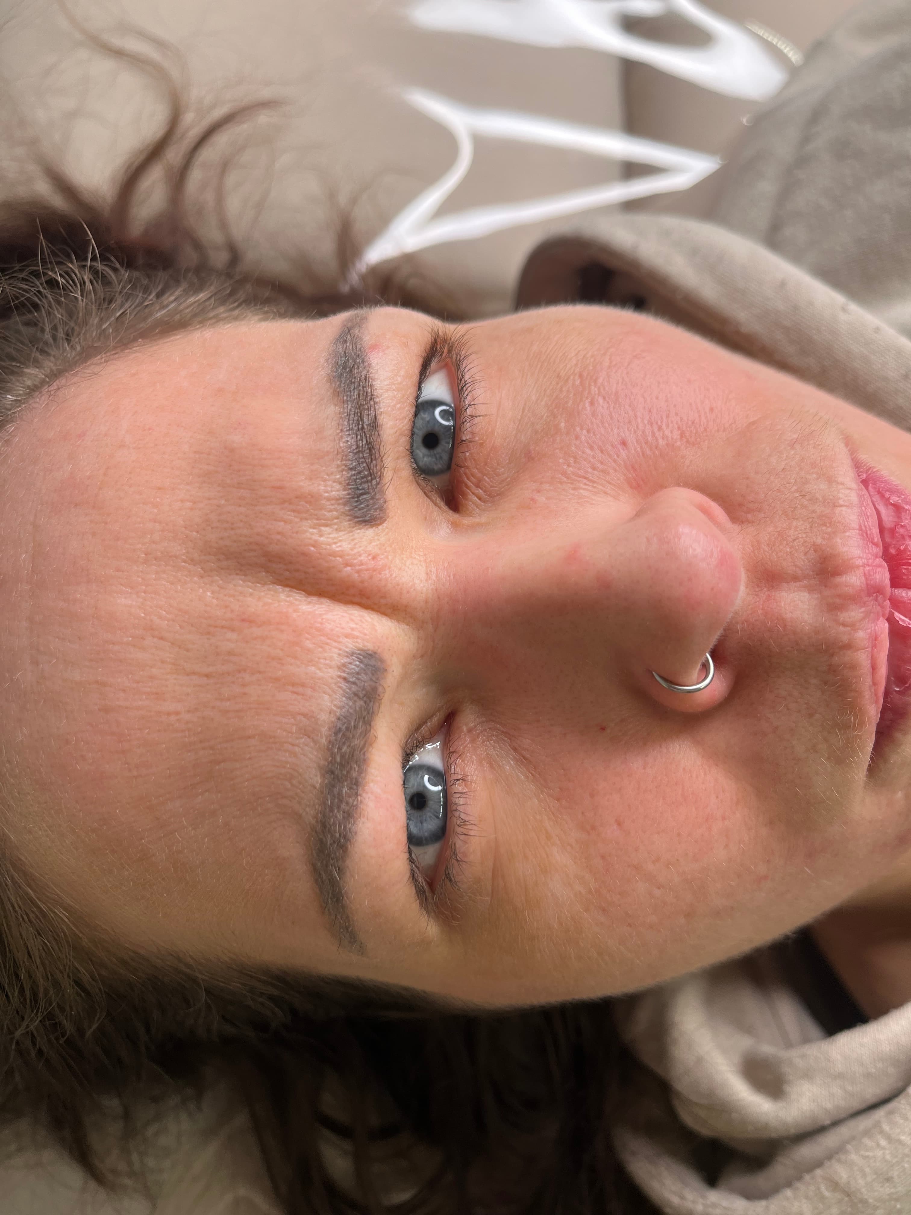 Före botox — synlig glabella-linje mellan ögonbrynen