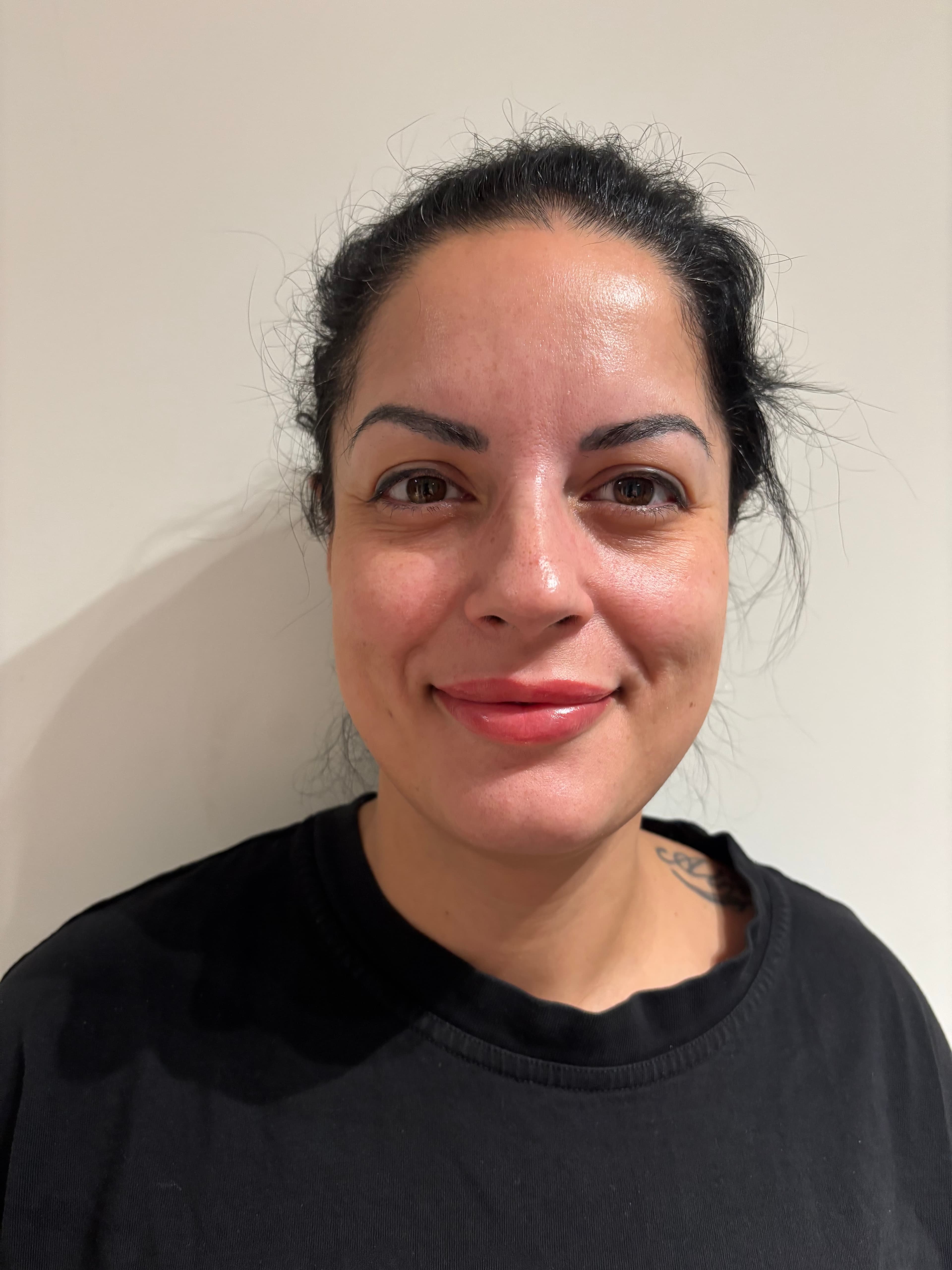 Efter botox — slätare panna med bibehållet naturligt uttryck