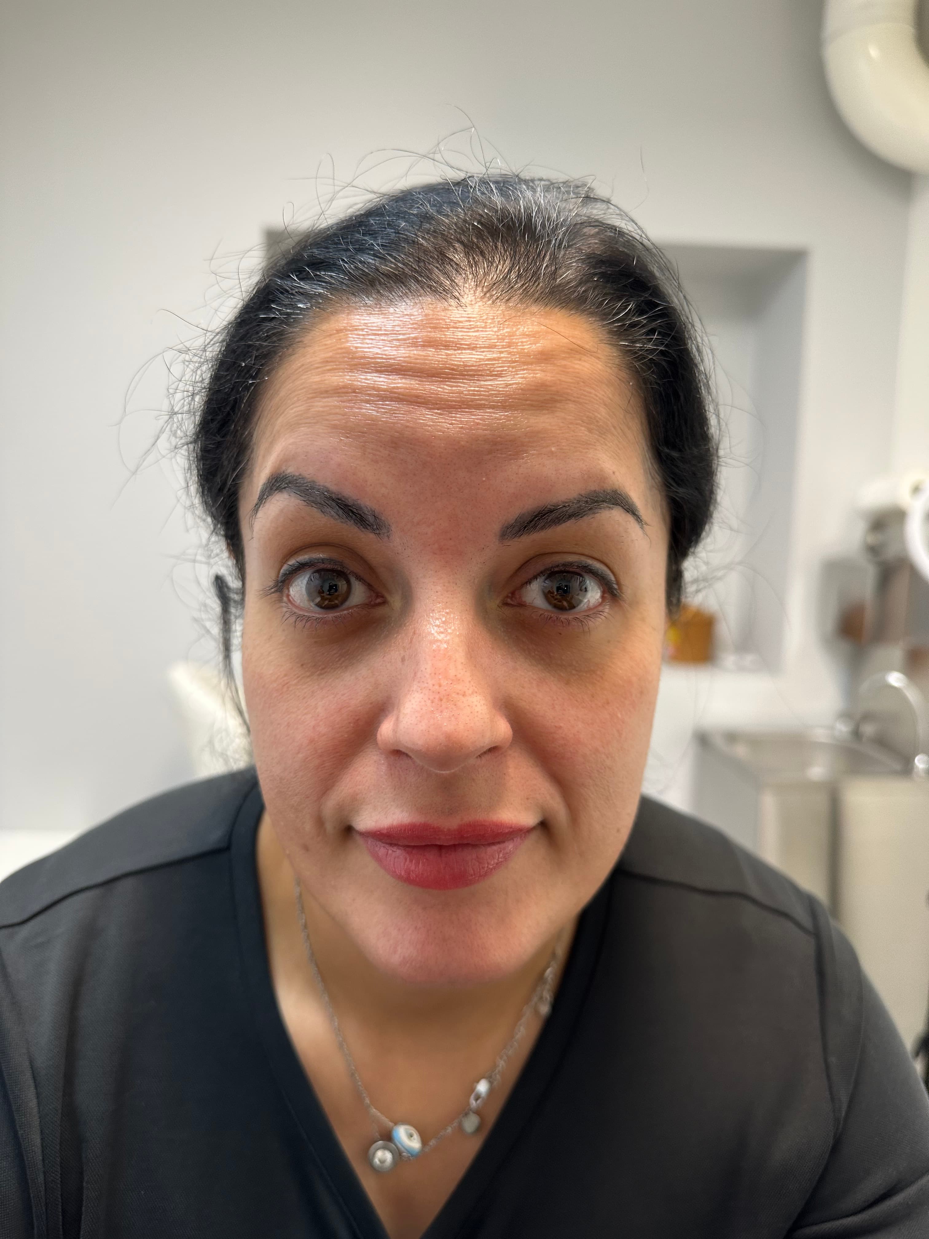 Före botox — synliga dynamiska linjer i pannan
