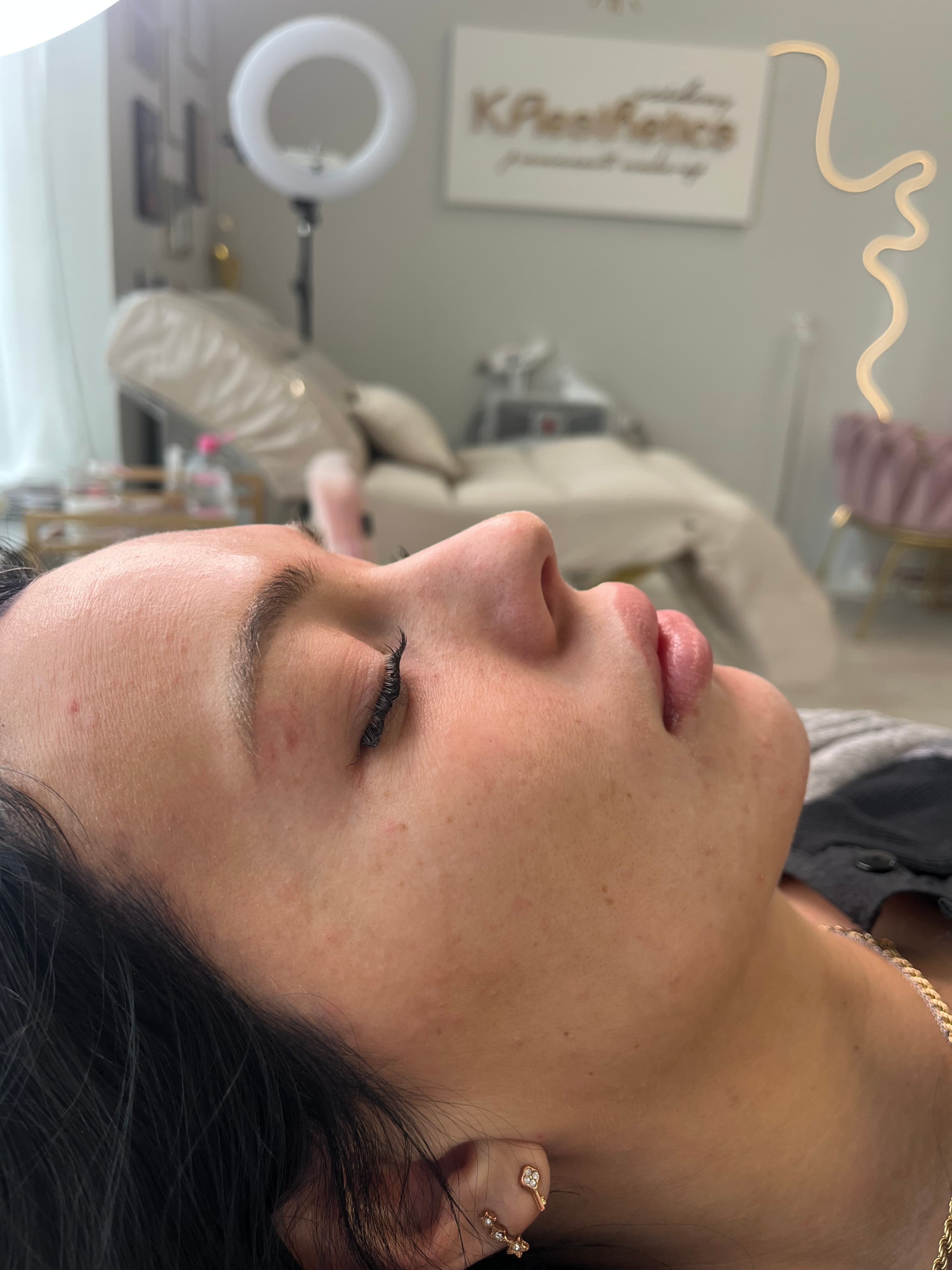 Före läppfiller — naturlig läppform