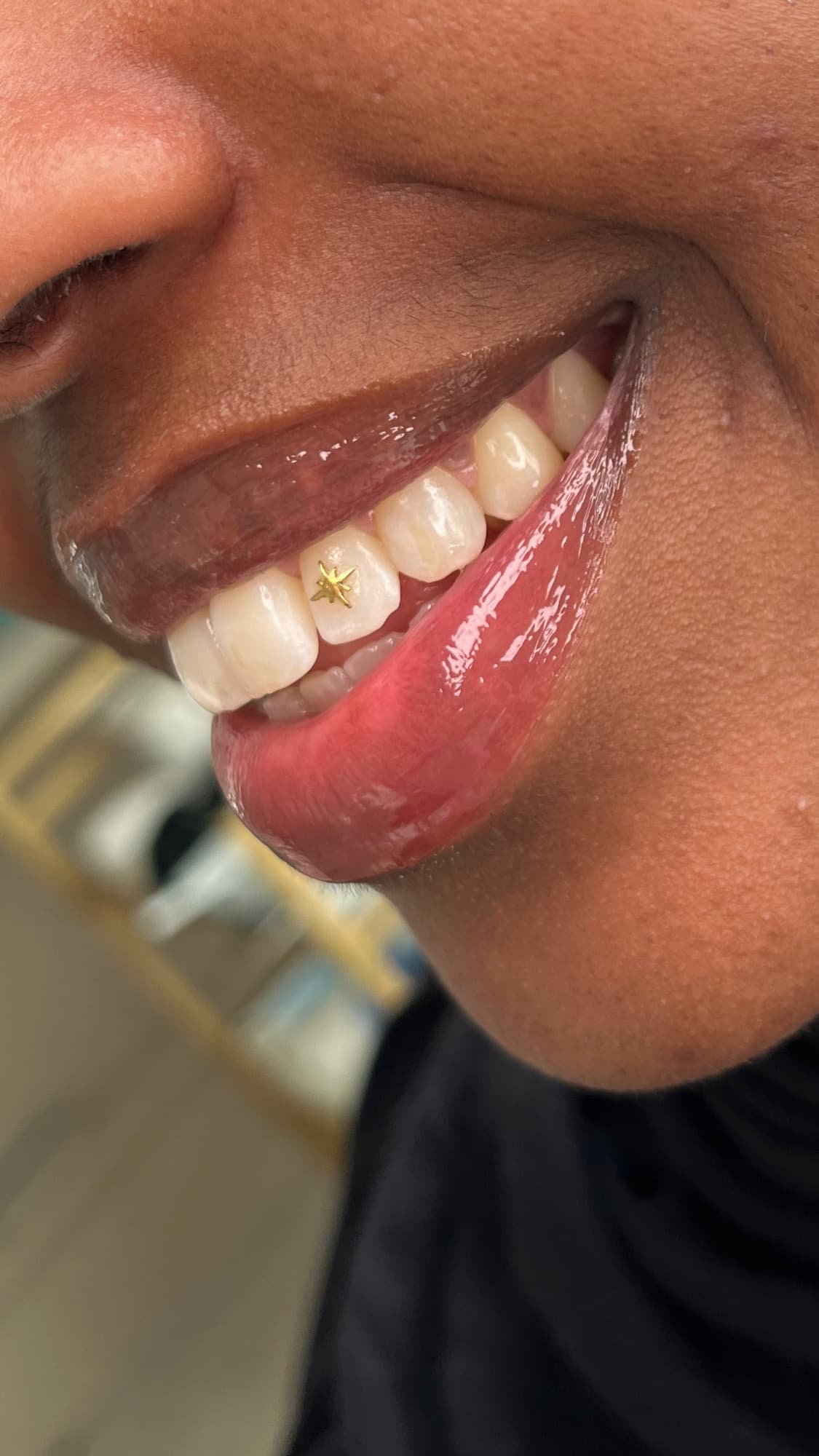 Tandsmycke / tooth gem applicerat på Cherry On Top Clinic i Sollentuna.
